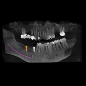 800×800-Impantatplanung-2 Implantat