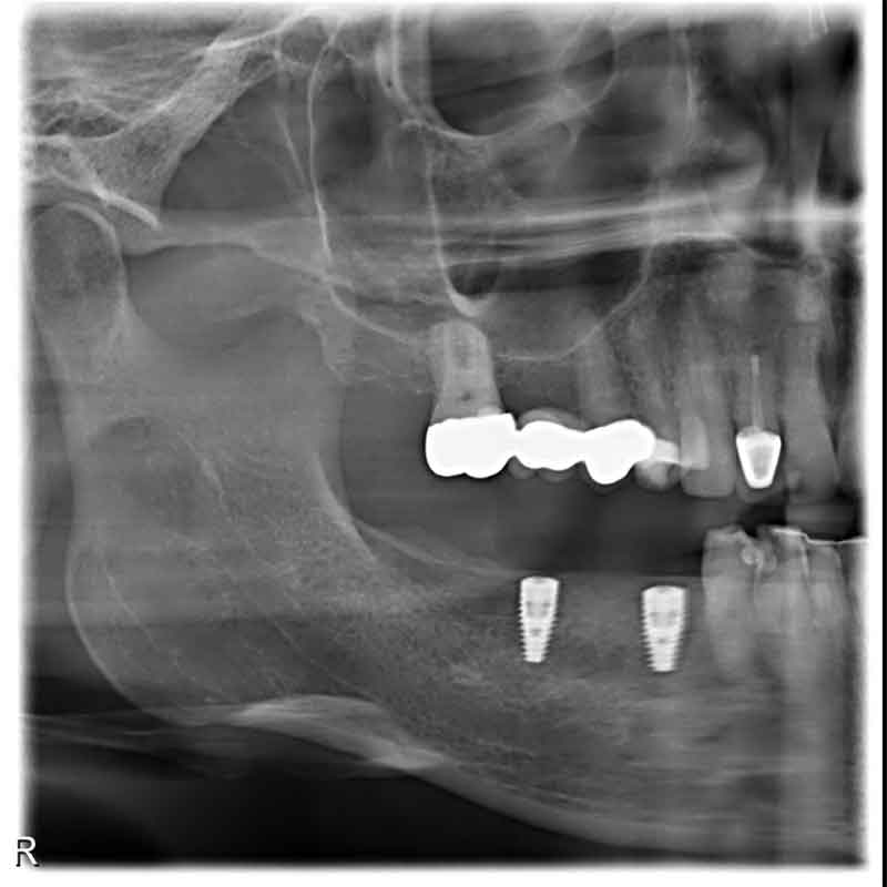 Implantat / Kieferknochenaufbau